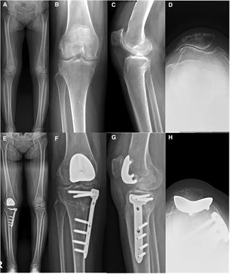 Patellofemoral arthroplasty in combination with high tibial osteotomy can achieve good outcome for patients with medial-patellofemoral osteoarthritis